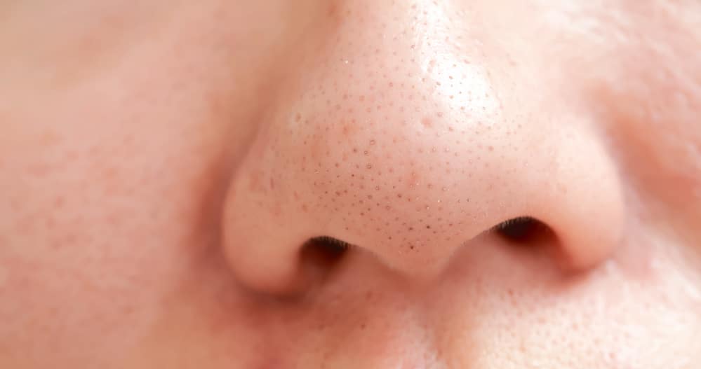 closeup on woman with blackheads on nose